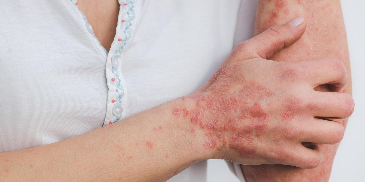 psoriasis-5996424_1280