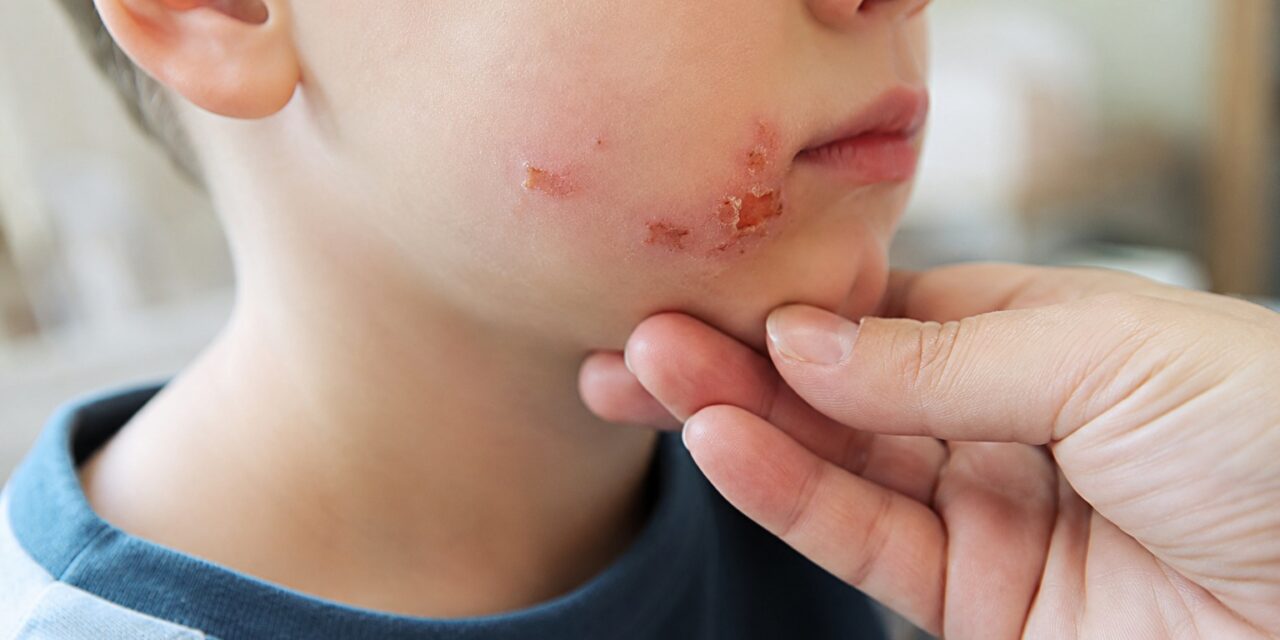 impetigo
